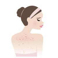 The woman with body acne illustration isolated on white background. Acne, pimples, blackheads, comedones, whiteheads, papule, pustule, nodule and cyst on back. Skin care and beauty concept. vector