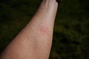 un ampolla marca desde un mosquito mordedura en el humano cuerpo, un rojo Mancha desde un mosquito morder, enrojecimiento de el piel, Comezón en el cuerpo. foto