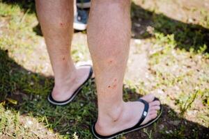 Red dots on human legs, bites of small blood-sucking insects, damage to the skin, itching and irritation of blisters, midge bite, pain in the legs. photo