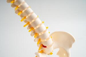 Lumbar spine displaced herniated disc fragment, spinal nerve and bone. Model for treatment medical in the orthopedic department. photo