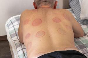 Shot of the female doctor in uniform against the white wall examining mid age male patient, performing cupping therapy. Healthcare photo