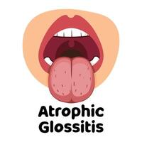 Atrophic Glossitis llustration vector
