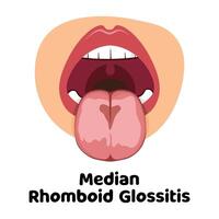 mediana romboidal glositis ilustración vector