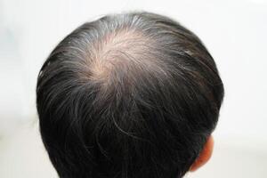 Bald head in man, hair loss treatment health problem. photo