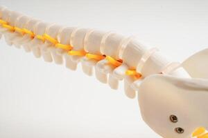 Spinal nerve and bone, Lumbar spine displaced herniated disc fragment, Model for treatment medical in the orthopedic department. photo