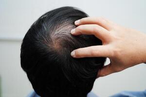 Bald head in man, hair loss treatment health problem. photo