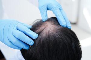 médico toque negrita cabeza en hombre, pelo pérdida tratamiento salud problema. foto