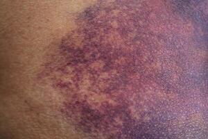 Bruise on the buttock skin injury from accident at home. photo