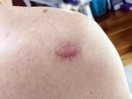 keloid scar on the her shoulder of a man photo