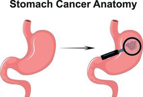 Stomach Cancer Anatomy Science Diagram illustration vector