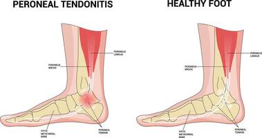 PERONEAL TENDONITIS Science Illustration vector