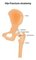 Hip Fracture Anatomy Science Design Illustration Diagram vector