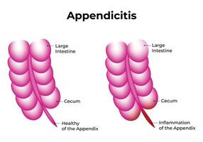 Appendicitis Science Design Illustration Diagram vector