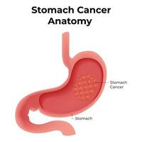 estómago cáncer anatomía diseño ilustración diagrama vector