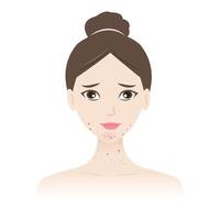 The woman with acne on jawline and neck illustration isolated on white background. Acne, pimples, blackheads, comedones, whiteheads, papule, pustule, nodule, cyst on face and neck. vector