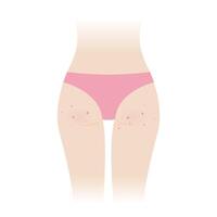 Acne on woman buttocks illustration isolated on white background. Pimples, comedone, papule, pustule, nodule and cyst on the bottom, hip, ass of woman body. Skin care and skin problem concept. vector
