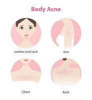 Acne on face and body woman icon set on white background. Pimples, blackheads, comedones, whiteheads, papule, pustule, nodule, cyst on jawline, neck, arm, chest and back. Skin problem concept. vector