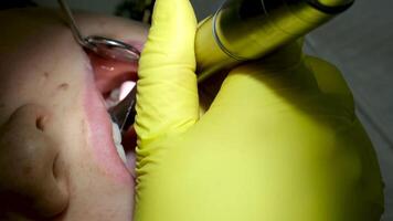 tandheelkunde adolescentie een dokter in geel handschoenen vult een tand van een jong meisje voor een vrouw detailopname in tandheelkunde Bij de tandarts drogen de tand met licht nieuw technologieën modern kliniek video