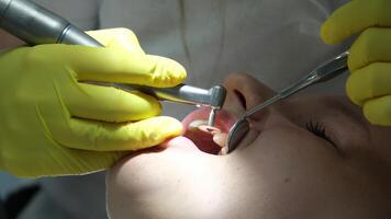 dentisterie adolescence une médecin dans Jaune gants remplit une dent de une Jeune fille pour une femme fermer dans dentisterie à le dentiste séchage le dent avec lumière Nouveau les technologies moderne clinique video