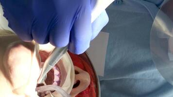 professionale denti pulizia nel un' dentale clinica, rimozione pietre e placca, l'applicazione dipingere per denti così quello un' strato di pietre è visibile, speciale più recente dispositivi nel dentisti, blu guanti, blu tute video