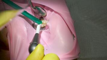 fechar acima cenas do dentista trabalhando dente o preenchimento dentro moderno clínica. saúde. paciente. procedimento video