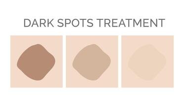 Dark Spots Removal Treatment Illustration vector