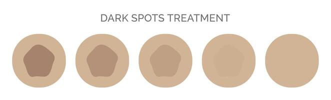 Dark Spots Removal Treatment Illustration vector