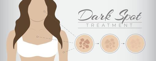 Dark Spot Treatment Illustration Design with Woman and Melasma Skin Pigmentation vector