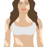 mujer con vitiligo aislado ilustración vector