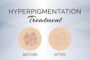 hiperpigmentación tratamiento antes de y después ilustración diseño vector