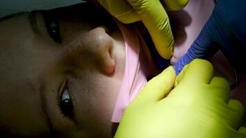 odontología adolescencia un médico en amarillo guantes llena un diente de un joven niña para un mujer de cerca en odontología a el dentista el secado el diente con ligero nuevo tecnologías moderno clínica video