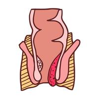 internal hemorrhoids stage 3 illustration vector