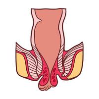 external hemorrhoids stage 4 illustration vector