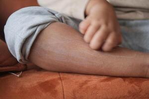 a kid suffering from itching skin on feet photo