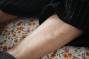 feet with vitiligo skin condition. photo