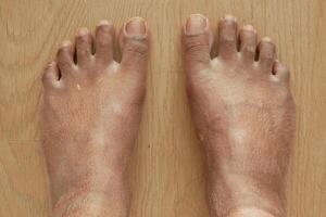 Closeup view of dry human feet skin . photo