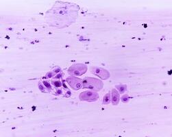 Paps smear analysis, Superficial squamous cell, metaplastic squamous cell, koilocytes cell. HPV related change photo