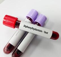 Blood sample for Phenytoin test, therapeutic drug, to maintain a therapeutic level and diagnose potential for toxicity photo