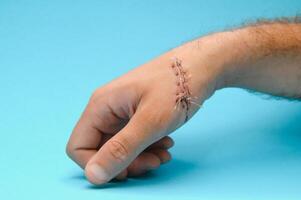 Suture wound on hand,Pain of accident concept photo