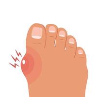 Foot with painful bunion. Healthy and sick feet. Healthcare and medicine. Illustration. vector