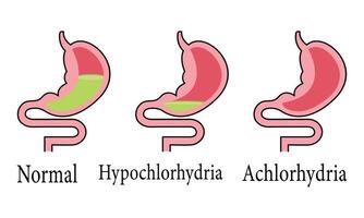 Scientific Designing of Normal Cell Hypochlorhydria and Achlorhydria. vector