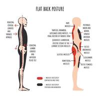 Flat back posture. The side view shows characteristic decrease natural curves of spine, pelvis rotation, stretched and weakened, shortened and tens muscles. vector