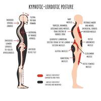 Kyphotic lordotic posture. The side view shows deformation of rounded shoulders and hyperlordosis, pelvis rotation, stretched and weakened, shortened and tens muscles. vector