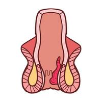 internal hemorrhoids illustration vector