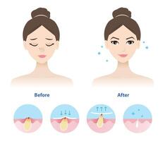 Comparison of woman face before and after blackhead removal illustration isolated on white background. Icon set of blackhead treatment process, apply, peel off, unclogging and tighten pore. vector