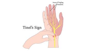 Carpal Tunnel Anatomy Diagram Illustration Design. vector