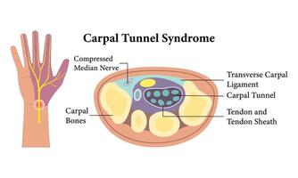 Carpal Tunnel Anatomy Diagram Illustration Design. vector