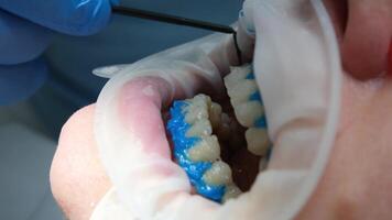 liquido cofferdam per isolato il gengive a partire dal il azione di un' candeggio agente optragat rotante spargitore avvicinamento di il del paziente denti nel il processi di imbiancamento nel il dentale clinica blu guanti video