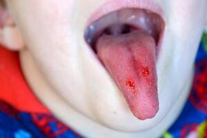 Close-up of lips, tongue, protrusion of blood. Child's bitten tongue. photo