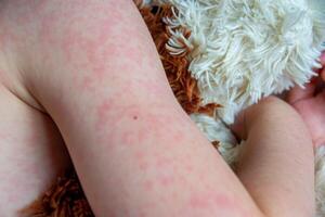 Viral disease. Measles rash on the body of the child. Allergy photo